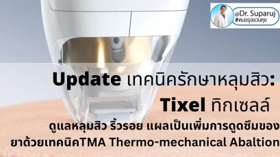 Update เทคนิครักษาหลุมสิว: Tixel ทิ๊กเซลล์ รักษาหลุมสิว ริ้วรอย แผลเป็น เพิ่มการดูดซึมยาด้วยเทคนิค TMA = Thermo-mechanical Abaltion