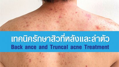 เทคนิครักษาสิวที่หลังและลำตัว Back ance and Truncal acne Treatment