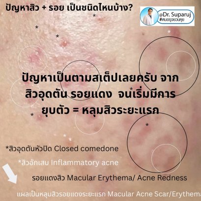 ปัญหาสิว + รอย เป็นชนิดไหนบ้าง?