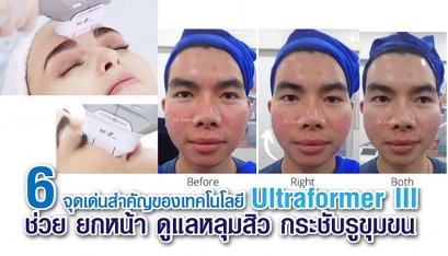 6 จุดเด่นสำคัญของเทคโนโลยี Ultraformer III ช่วย ยกหน้า ดูแลหลุมสิว กระชับรูขุมขน