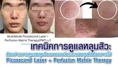 เทคนิคการดูแลหลุมสิว: ตัวอย่างการดูแลหลุมสิวแบบขอบชัดและแบบยุบตัวด้วยการใช้ Picosecond Laser + Perfusion Matrix Therapy