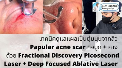 เทคนิคดูแลแผลเป็นตุ่มนูนจากสิว Papular acne scar ที่จมูก + คาง ด้วย Fractional Discovery Picosecond Laser + Deep Focused Ablative Laser