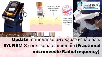 Update เทคนิคยกกระชับผิว หลุมสิว ดูแลปัญหาเม็ดสี ฝ้า+เส้นเลือด: SYLFIRM X นวัตกรรมคลื่นวิทยุแบบเข็ม (Fractional microneedle Radiofrequency)