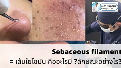 Sebaceous filament = เส้นใยไขมัน คืออะไรมี ?ลักษณะอย่างไร ? ดูแลได้อย่างไร? 