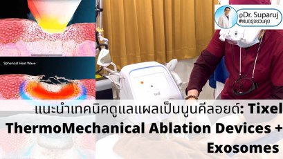 แนะนำเทคนิคดูแลแผลเป็นนูนคีลอยด์: รักษาแผลเป็นนูนด้วยทิกเซลล์ Tixel Fractional ThermoMechanical Ablation Devices + Exosomes