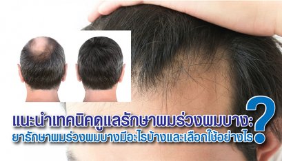แนะนำเทคนิคดูแลรักษาผมร่วงผมบาง: ยารักษาผมร่วงผมบางมีอะไรบ้างและเลือกใช้อย่างไร?