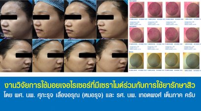 งานวิจัยการใช้มอยเจอไรเซอร์ที่มีเซราไมด์ร่วมกับการใช้ยารักษาสิว โดย ผศ. นพ. ศุภะรุจ เลื่องอรุณ (หมอรุจ) และ รศ. นพ. เทอดพงศ์ เต็มภาค ครับ