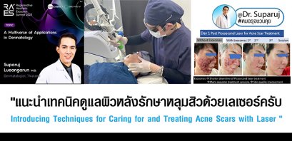 "แนะนำเทคนิคดูแลผิวหลังรักษาหลุมสิวด้วยเลเซอร์ครับIntroducing Techniques for Caring for and Treating Acne Scars with Laser"