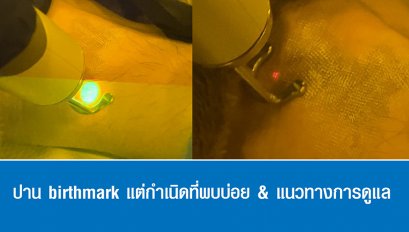 ปาน birthmark แต่กำเนิดที่พบบ่อย & แนวทางการดูแล