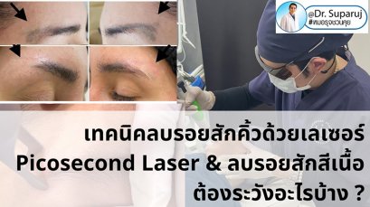 เทคนิคลบรอยสักคิ้ว ด้วยเลเซอร์ Picosecond Laser และลบรอยสักสีเนื้อต้องระวังอะไรบ้าง ?