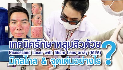 เทคนิครักษาหลุมสิวด้วย Picosecond Laser with Micro Lens array (MLA) มีกลไกล & จุดเด่นอย่างไร?