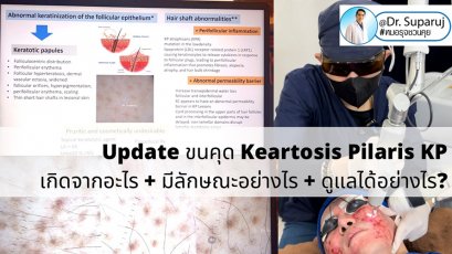 Update ขนคุด Keartosis Pilaris KP เกิดจากอะไร + มีลักษณะอย่างไร + ดูแลได้อย่างไร?