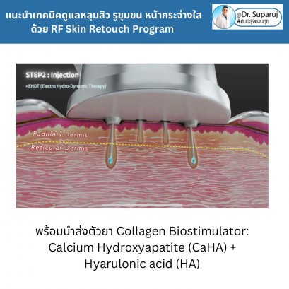 แนะนำเทคนิคดูแลหลุมสิว รูขุมขน หน้ากระจ่างใสด้วย RF Skin Retouch Program