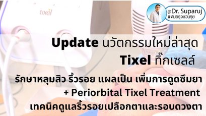 Update นวัตกรรมใหม่ล่าสุด Tixel ทิ๊กเซลล์ รักษาหลุมสิว ริ้วรอย แผลเป็น + Periorbital Tixel Treatment ดูแลริ้วรอยเปลือกตาและรอบดวงตาด้วยเทคนิค TMA = Thermo-mechanical Abaltion
