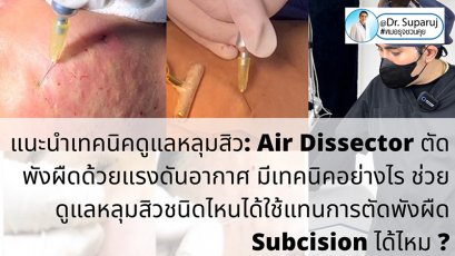 แนะนำเทคนิคดูแลหลุมสิว: Air Dissector ตัดพังผืดด้วยแรงดันอากาศ มีเทคนิคอย่างไร ช่วยดูแลหลุมสิวชนิดไหนได้ ใช้แทนการตัดพังผืด Subcision ได้ไหม ?