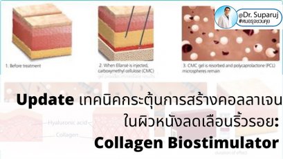Update เทคนิคกระตุ้นการสร้างคอลลาเจนในผิวหนังลดเลือนริ้วรอย: Collagen Biostimulator