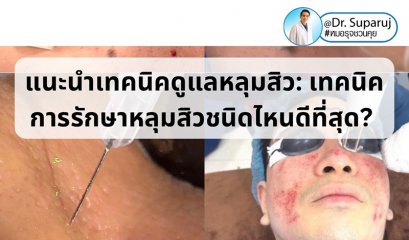 แนะนำเทคนิคดูแลหลุมสิว: เทคนิคการรักษาหลุมสิวชนิดไหนดีที่สุด?