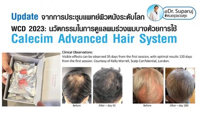 Update จากการประชุมแพทย์ผิวหนังระดับโลก WCD 2023: นวัตกรรมในการดูแลผมร่วงผมบางด้วยการใช้ Calecim Advanced Hair System