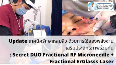 Update เทคนิครักษาหลุมสิว ด้วยการใช้สองพลังงานเสริมประสิทธิภาพร่วมกัน: Secret DUO Fractional RF Microneedle + Fractional ErGlasss Laser
