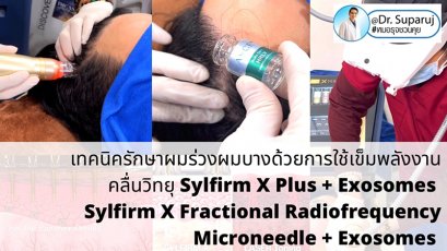 แนะนำเทคนิคดูแลผมร่วงผมบางด้วย Sylfirm X Fractional RF Microneedle + Exosomes for Hair Loss Treatment
