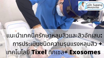 แนะนำเทคนิครักษาหลุมสิวและสิวอักเสบ: ประเมินชนิดความรุนแรงหลุมสิว + เทคโนโลยี Tixel ทิกเซล+ Exosomes