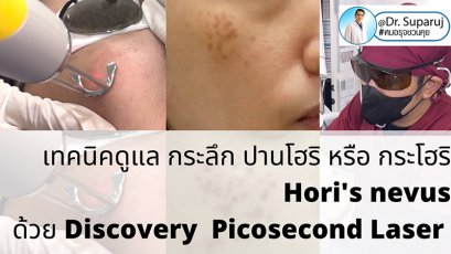 เทคนิครักษากระโฮริ กระลึก ปานโฮริ (Hori's nevus) ด้วยเลเซอร์ Discovery Picosecond Laser