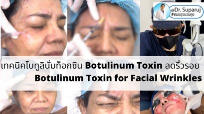 เทคนิคโบทูลินั่มท็อกซิน Botulinum Toxin ลดริ้วรอย Botulinum Toxin for Facial Wrinkles