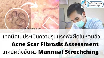  เทคนิคประเมินความรุนแรงพังผืดหลุมสิว Acne Scar Fibrosis Assessment : เทคนิคดึงยืดผิว Mannual Strechching (ง่ายๆ ประเมินได้ด้วยตัวเองครับ )