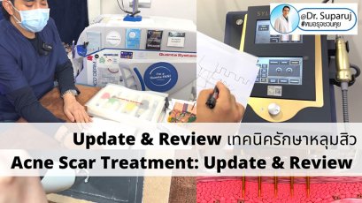 Update & Review เทคนิครักษาหลุมสิว (Acne Scar Treatment: Update & Review)