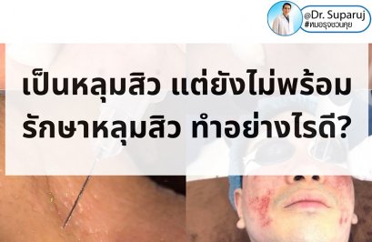 เป็นหลุมสิว แต่ยังไม่พร้อมรักษาหลุมสิว ทำอย่างไรดี? (+ เทคนิคการ เลือกใช้วิธีรักษาลุมสิวเบื้องต้นครับ)