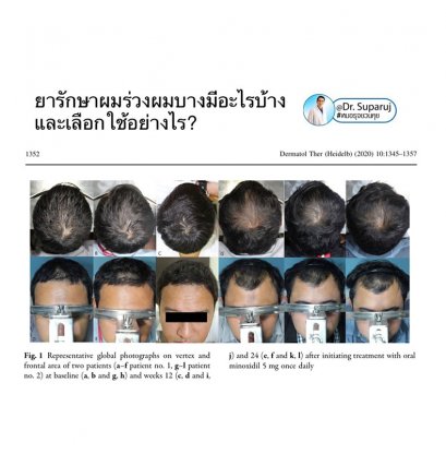 แนะนำเทคนิคดูแลรักษาผมร่วงผมบาง: ยารักษาผมร่วงผมบางมีอะไรบ้างและเลือกใช้อย่างไร?