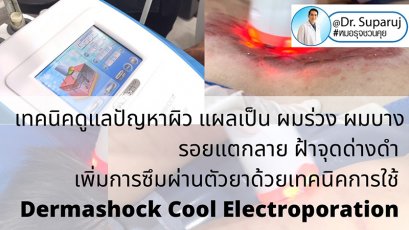 เทคนิคดูแลปัญหาผิว แผลเป็น ผมร่วง ผมบาง รอยแตกลาย ฝ้าจุดด่างดำ เพิ่มการซึมผ่านของตัวยาด้วยเทคนิคการใช้ Dermashock Cool Electroporation