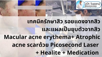 แนะนำเทคนิคดูแลรักษาสิวและหลุมสิว: ดูแลรอยแดงจากสิวและแผลเป็นยุบตัวจากสิว Acne + Macular acne erythema + Atrophic acne scar ดูแลด้วย Picosecond Laser + Healite + Medication