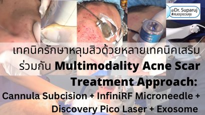 เทคนิครักษาหลุมสิวด้วยหลายเทคนิคเสริมร่วมกัน Multimodality Acne Scar Treatment Approach: Cannula Subcision + InfiniRF Microneedle + Discovery Pico Laser + Exosome