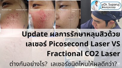 Update ผลการรักษาหลุมสิวด้วยเลเซอร์ Picosecond Laser VS Fractional CO2 Laser ต่างกันอย่างไร? เลเซอร์ชนิดไหนให้ผลดีกว่า?