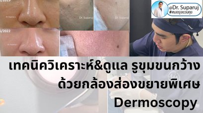 เทคนิควิเคราะห์ & รักษาขุมขนกว้าง Enlarged Facial Pore ด้วยกล้อส่องขยายพิเศษทางผิวหนัง Dermoscopy