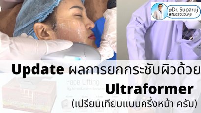 Update ผลการยกกระชับผิวด้วย Ultraformer III (เปรียบเทียบแบบครึ่งหน้าให้เห็นชัดๆครับ)