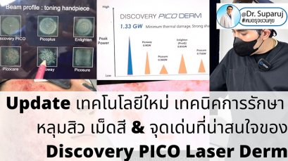 Update เทคโนโลยีใหม่ เทคนิคการรักษาหลุมสิว เม็ดสี & จุดเด่นที่น่าสนใจของ Discovery PICO Laser Derm