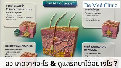 สิว เกิดจากอะไร & ดูแลรักษาได้อย่างไร ?