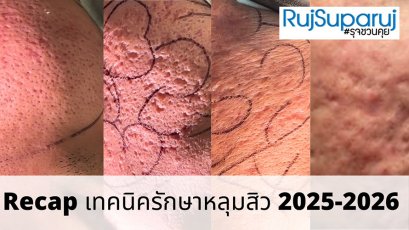 Recap เทคนิครักษาหลุมสิว 2025-2026