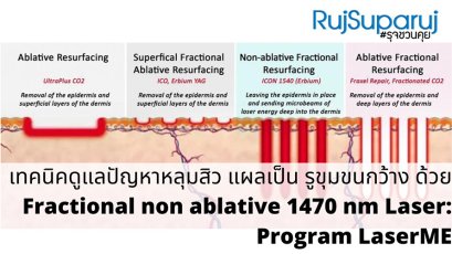 เทคนิคดูแลปัญหาหลุมสิว แผลเป็น รูขุมขนกว้าง ด้วย Fractional non ablative 1470 nm Laser: Program LaserME