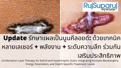 Update รักษาแผลเป็นนูนคีลอยด์: ด้วยเทคนิคหลายเลเซอร์ + พลังงาน + ระดับความลึก ร่วมกันเสริมประสิทธิภาพ Combination Laser Therapy for Keloid and Hypertrophic Scars: Integrating Multiple Wavelengths, Energy Parameters, and Depth-Specific Treatment Levels