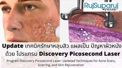 Update เทคนิครักษาหลุมสิวและแผลเป็นด้วย โปรแกรม Discovery Picosecond Laser