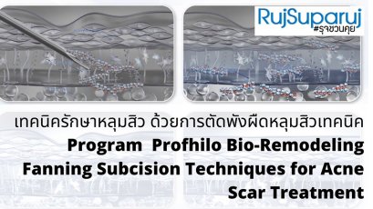 เทคนิครักษาหลุมสิว ด้วยการตัดพังผืดหลุมสิวเทคนิค Program Profhilo Bio-Remodeling Fanning Subcision Techniques for Acne Scar Treatment