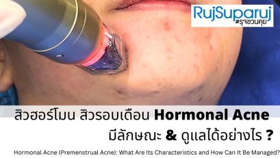 สิวฮอร์โมน สิวรอบเดือน Hormonal Acne มีลักษณะ & ดูแลได้อย่างไร ?