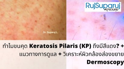 "ทำไมขนคุด Keratosis Pilaris (KP) ถึงมีสีแดง? + แนวทางการดูแล + วิเคราะห์ผิวกล้องส่องขยาย Dermoscopy " วันนี้หมอจะพามาวิเคราะห์ด้วยกล้องขยายผิวหนังหรือ Dermoscopy กันครับ