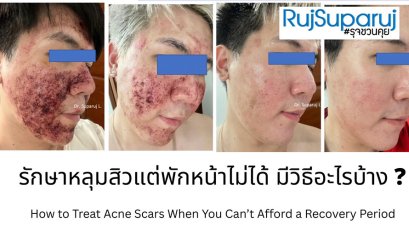 รักษาหลุมสิวแต่พักหน้าไม่ได้ มีวิธีอะไรบ้าง ?