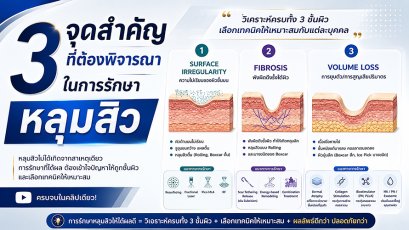 3 จุดสำคัญที่ต้องพิจารณาในการรักษาหลุมสิว: Surface Irregularity, Fibrosis และ Volume Loss