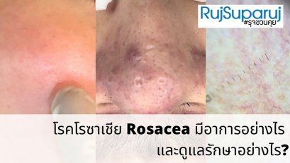 โรคโรซาเชีย Rosacea มีอาการอย่างไร และดูแลรักษาอย่างไร?