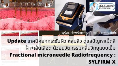 Update เทคนิคยกกระชับผิว หลุมสิว ดูแลปัญหาเม็ดสี ฝ้า+เส้นเลือด ด้วยนวัตกรรมคลื่นวิทยุแบบเข็ม Fractional microneedle Radiofrequency : SYLFIRM X